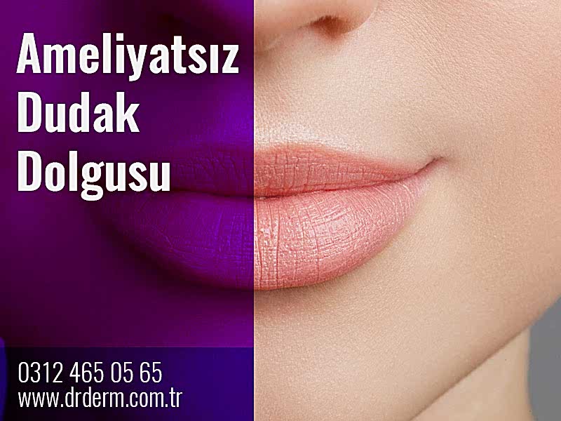 Ameliyatsız Dudak Dolgusu